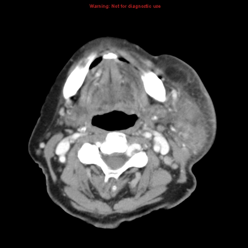 Ameloblastoma (Radiopaedia 27437-27631 A 48).jpg