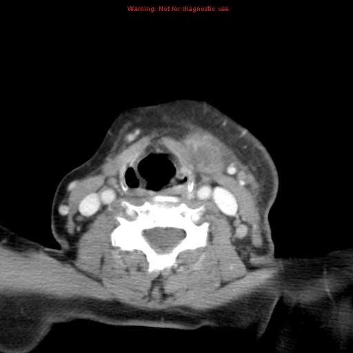 Ameloblastoma (Radiopaedia 27437-27631 A 61).jpg