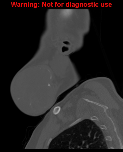 Ameloblastoma (Radiopaedia 33126-34164 Sagittal bone window 15).jpg