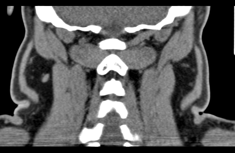 Ameloblastoma (Radiopaedia 33677-34806 Coronal non-contrast 56).png