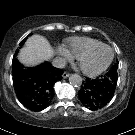 File:Amiodarone-induced pulmonary fibrosis (Radiopaedia 82355-96460 Axial non-contrast 45).jpg