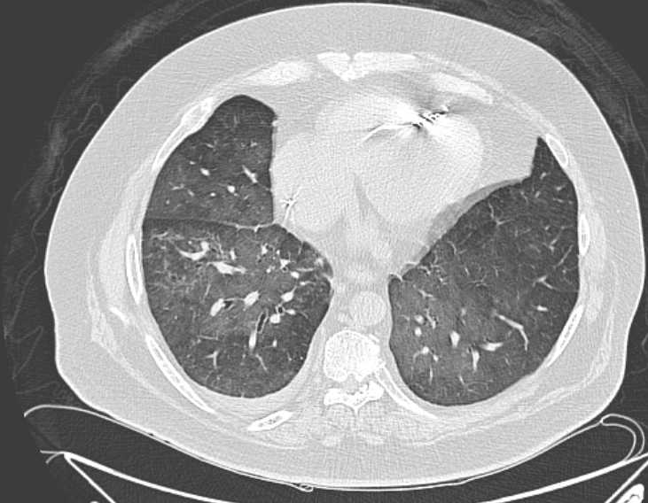 Amiodarone lung (Radiopaedia 62514-70769 Axial lung window 62).jpg