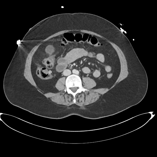 File:Amoebic liver abscess (Radiopaedia 52611-58530 A 57).png