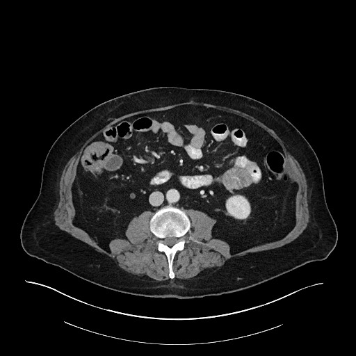 Ampullary adenocarcinoma (Radiopaedia 59373-66734 C 88).jpg
