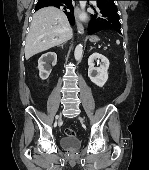 Ampullary adenocarcinoma (Radiopaedia 59373-66734 D 68).jpg