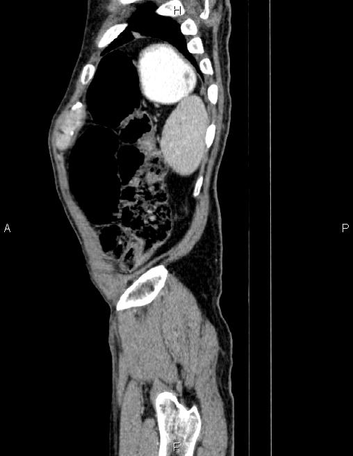 Ampullary adenocarcinoma (Radiopaedia 86093-102032 D 89).jpg