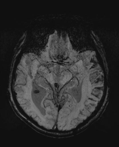 File:Amyloid angiopathy with inflammation (Radiopaedia 30360-31002 Axial SWI MIP 21).jpg