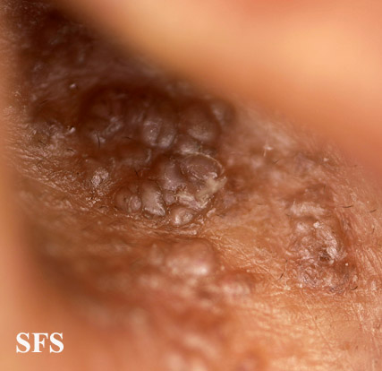 File:Amyloidosis (Dermatology Atlas 7).jpg