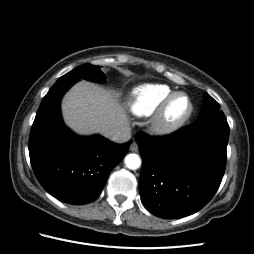 Amyloidosis - bronchial and diffuse nodular pulmonary involvement (Radiopaedia 60156-67745 A 42).jpg