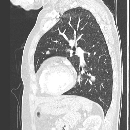 Amyloidosis - bronchial and diffuse nodular pulmonary involvement (Radiopaedia 60156-67745 Sagittal lung window 62).jpg