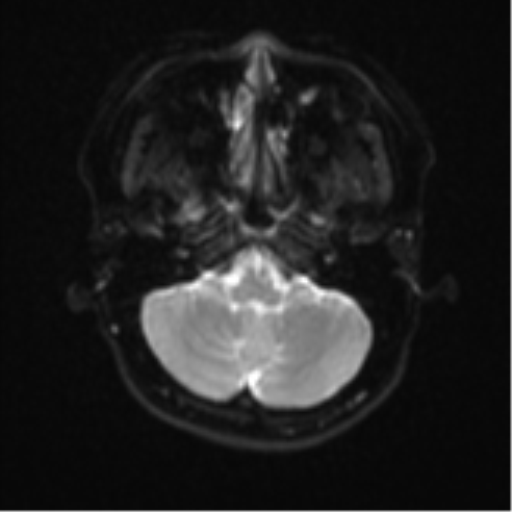 Anaplastic astroblastoma (Radiopaedia 55666-62194 Axial DWI 6).png