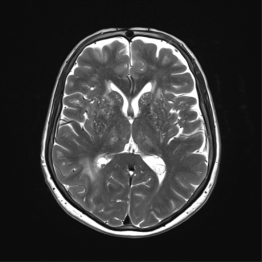 File:Anaplastic astrocytoma (Radiopaedia 86943-103160 Axial T2 21).png