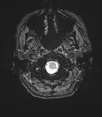 Anaplastic astrocytoma - thalamic glioma (Radiopaedia 59709-67115 G 4).png