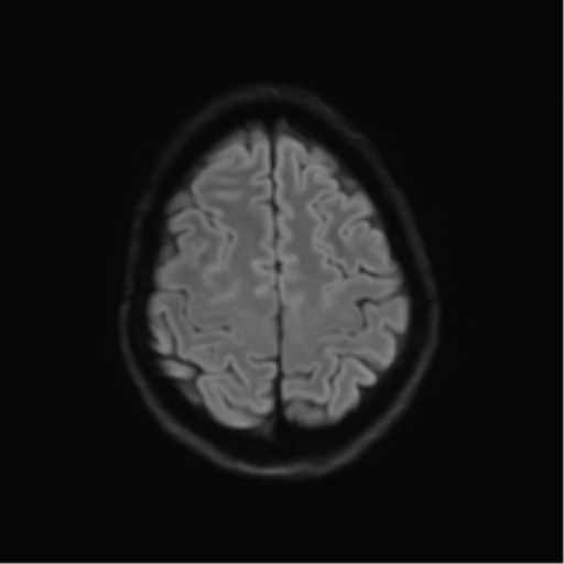 Anaplastic astrocytoma IDH mutant (Radiopaedia 50046-55341 Axial DWI 50).png