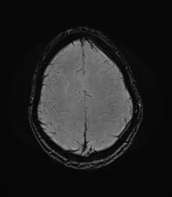 File:Anaplastic astrocytoma IDH mutant (Radiopaedia 50046-55341 Axial SWI 71).png