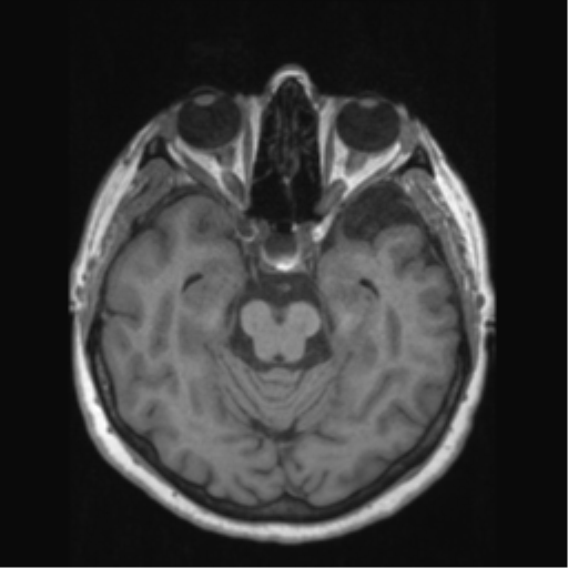 Anaplastic astrocytoma IDH wild-type (pseudoprogression) (Radiopaedia 42209-45276 Axial T1 60).png