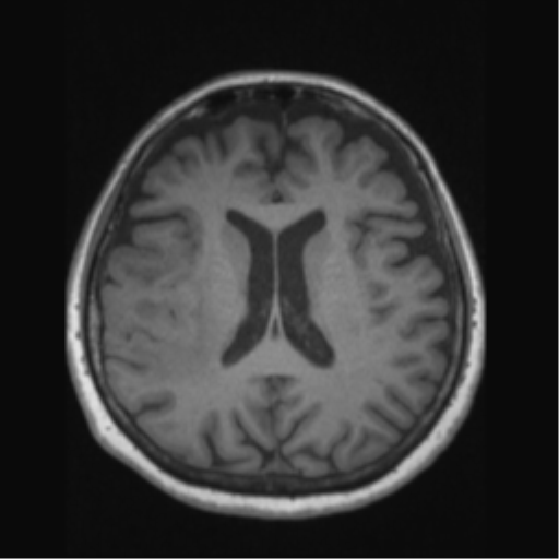 File:Anaplastic astrocytoma IDH wild-type (pseudoprogression) (Radiopaedia 42209-45276 Axial T1 92).png