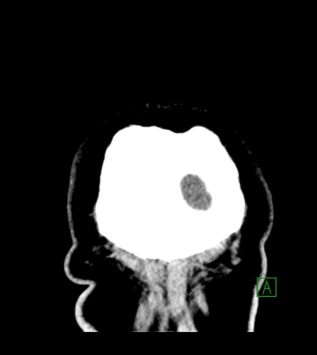 Anaplastic oligodendroglioma (Radiopaedia 79571-92753 Coronal non-contrast 68).jpg