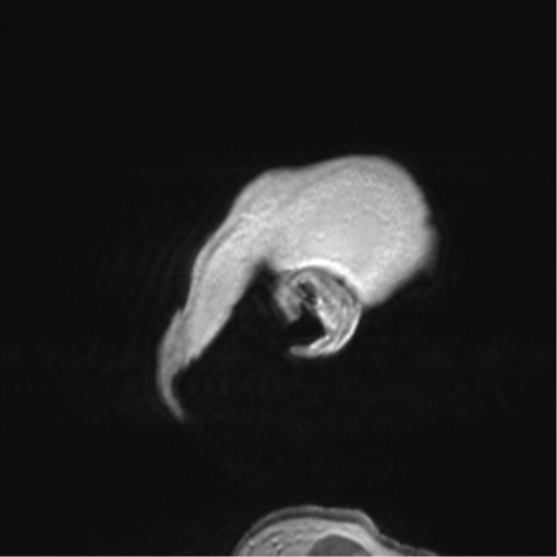 Anaplastic oligodendroglioma (Radiopaedia 83500-98599 Sagittal T1 C+ 9).png