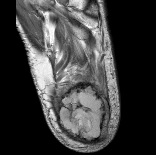 File:Aneurysmal bone cyst of the calcaneus (Radiopaedia 60669-68420 Axial PD 5).jpg