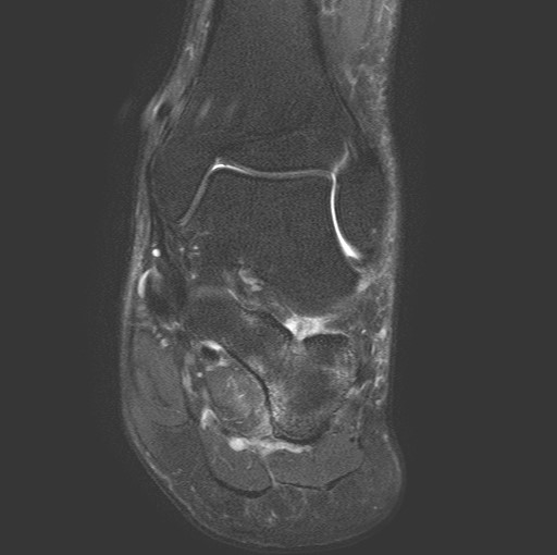 File:Aneurysmal bone cyst of the calcaneus (Radiopaedia 60669-68420 Coronal T2 fat sat 8).jpg