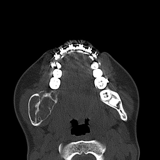 Aneurysmal bone cyst of the mandible (Radiopaedia 43280-46601 Axial bone window 31).jpg