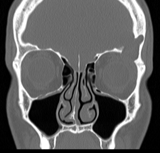 Angular epidermoid cyst (Radiopaedia 46908-51439 Coronal bone window 26).png