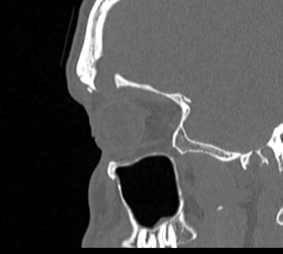 Angular epidermoid cyst (Radiopaedia 46908-51439 Sagittal bone window 71).png