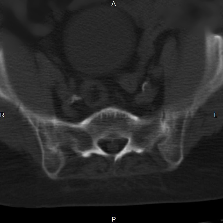 Ankylosing spondylitis (Radiopaedia 8748-9556 Axial bone window 50).jpg