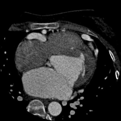 Anomalous left coronary artery from the pulmonary artery (ALCAPA) (Radiopaedia 40884-43586 A 36).jpg