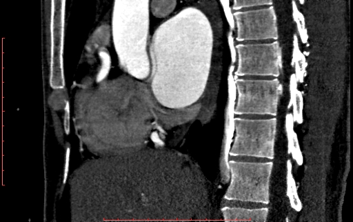 File:Anomalous left coronary artery from the pulmonary artery (ALCAPA) (Radiopaedia 70148-80181 C 93).jpg