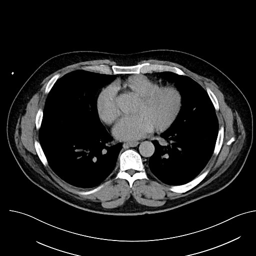 File:Anomalous origin of the left coronary artery with malignant course (Radiopaedia 77842-90126 Axial non-contrast 21).jpeg