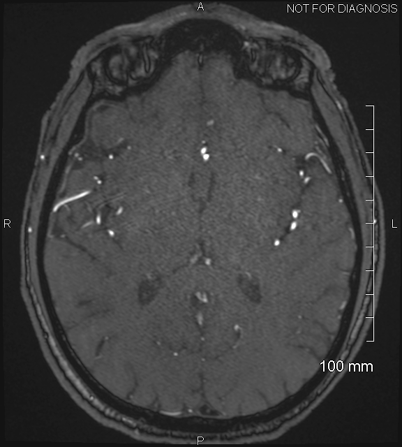 Anterior cerebral artery aneurysm (Radiopaedia 80683-94127 Axial MRA 131).jpg