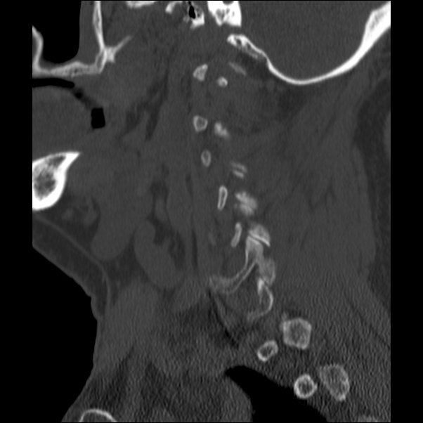 Anterior cervical postdiscectomy arthrodesis (Radiopaedia 32678-33646 Sagittal bone window 62).jpg