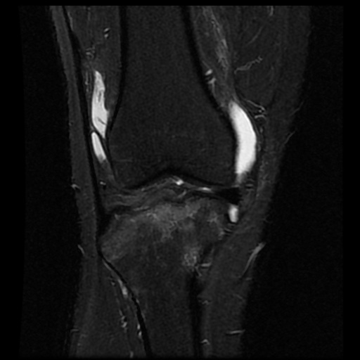 File:Anterior cruciate ligament avulsion fracture (Radiopaedia 58939-66193 Coronal STIR 7).jpg