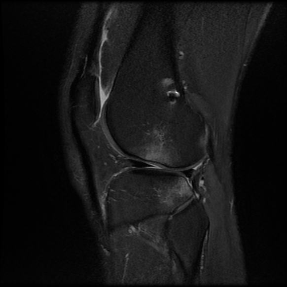 File:Anterior cruciate ligament graft tear and bucket-handle tear of medial meniscus (Radiopaedia 75867-87254 Sagittal PD fat sat 22).jpg