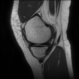 Anterior cruciate ligament rupture and posteromedial corner injury (Radiopaedia 67338-76723 Sagittal PD 43).jpg