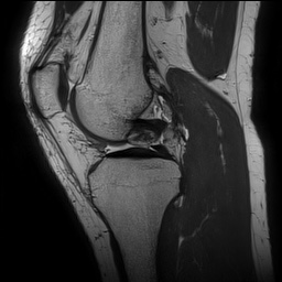 Anterior cruciate ligament rupture and posteromedial corner injury (Radiopaedia 67338-76723 Sagittal PD 72).jpg