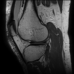 Anterior cruciate ligament rupture with Segond fracture (Radiopaedia 69043-78806 Sagittal PD 133).jpg