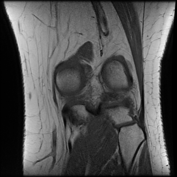 File:Anterior cruciate ligament tear, Wrisberg rip and bucket-handle tear of medial meniscus (Radiopaedia 75872-87266 Coronal T1 21).jpg