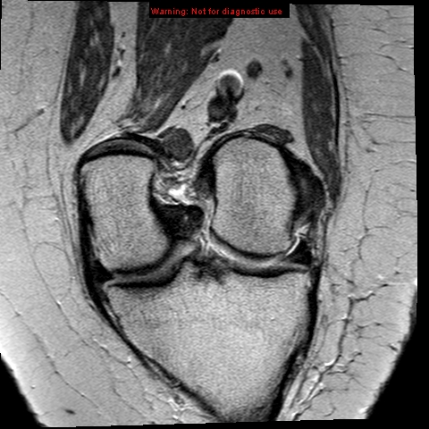 File:Anterior cruciate ligament tear (Radiopaedia 12329-12612 C 8).jpg