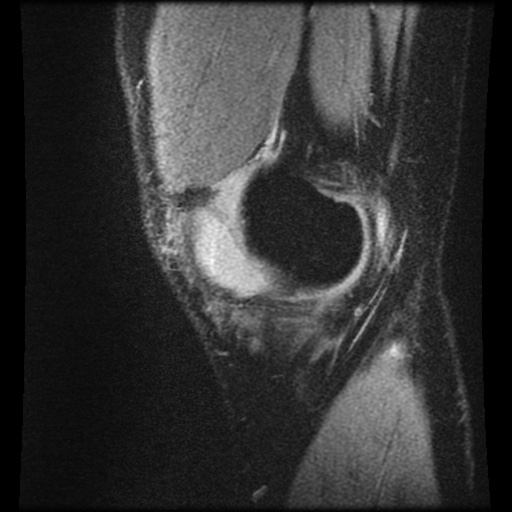 Anterior cruciate ligament tear (Radiopaedia 61500-69462 F 4).jpg
