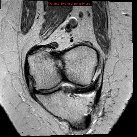 File:Anterior cruciate ligament tear - complete (Radiopaedia 12175-12514 Coronal PD 5).jpg