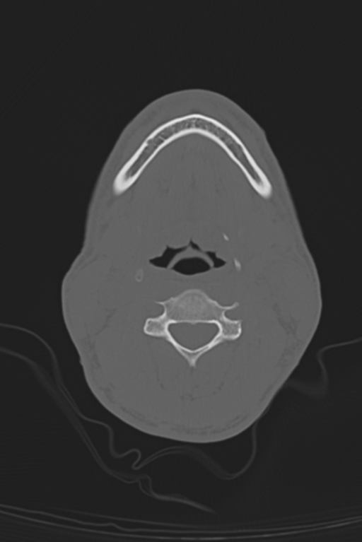 Anterior nasal spine fracture (Radiopaedia 46138-50494 Axial bone window 75).png