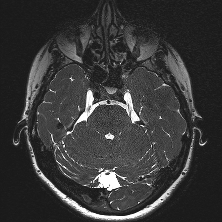 Anterior temporal encephalocele (Radiopaedia 82624-96808 Axial T2 high res 43).jpg