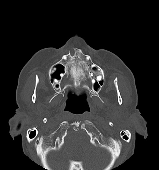 Anterior temporomandibular joint dislocation (Radiopaedia 59430-66784 Axial non-contrast 23).jpg
