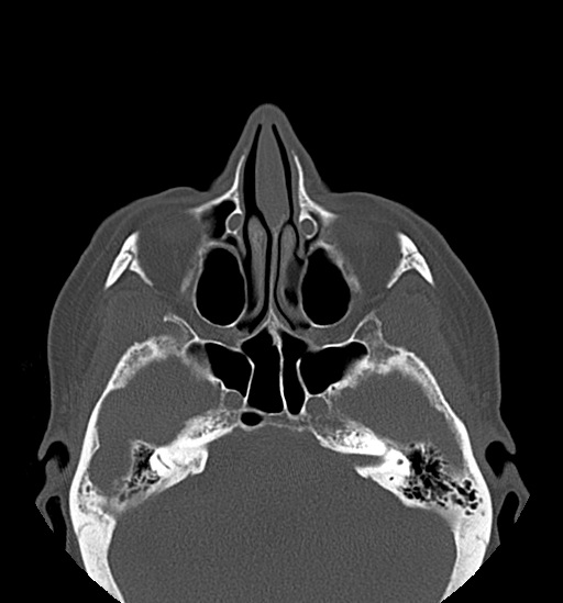 File:Anterior temporomandibular joint dislocation (Radiopaedia 59430-66784 Axial non-contrast 9).jpg