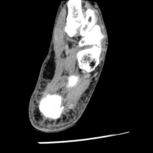 File:Anterior tibial artery false aneurysm (Radiopaedia 88984-105809 A 210).jpg