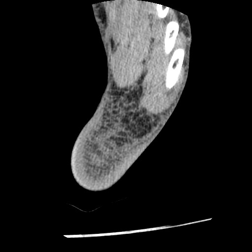 Anterior tibial artery false aneurysm (Radiopaedia 88984-105809 A 249).jpg