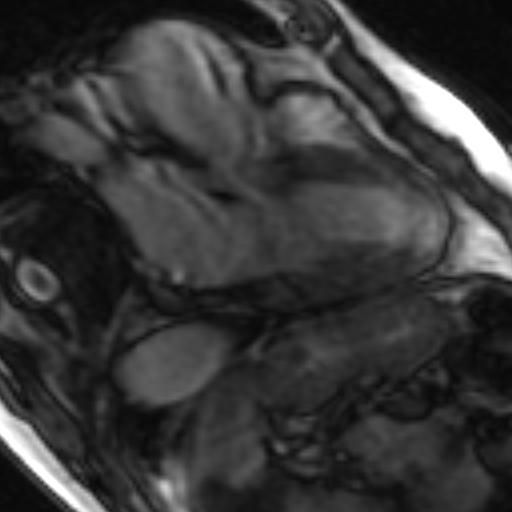 File:Anteroseptal hypokinesia after myocardial infarction (Radiopaedia 15978-15633 3 chamber view SSFE 27).jpg